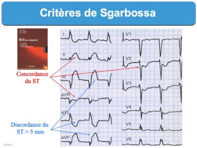 Critères de Sgarbossa e cardiogram