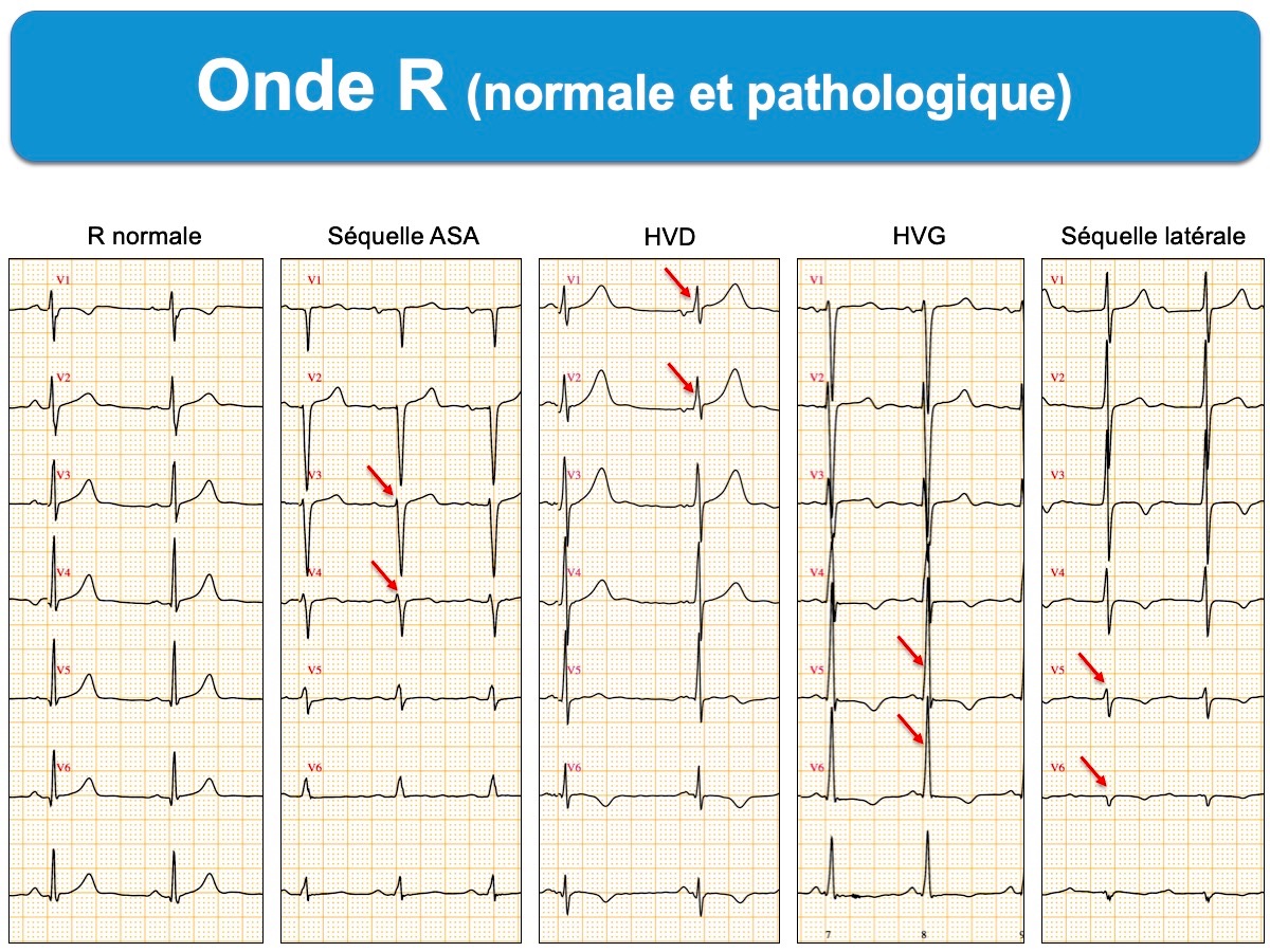 Onde R E Cardiogram