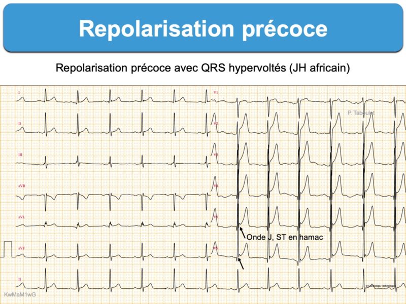 Repolarisation Pr Coce Ondes J E Cardiogram