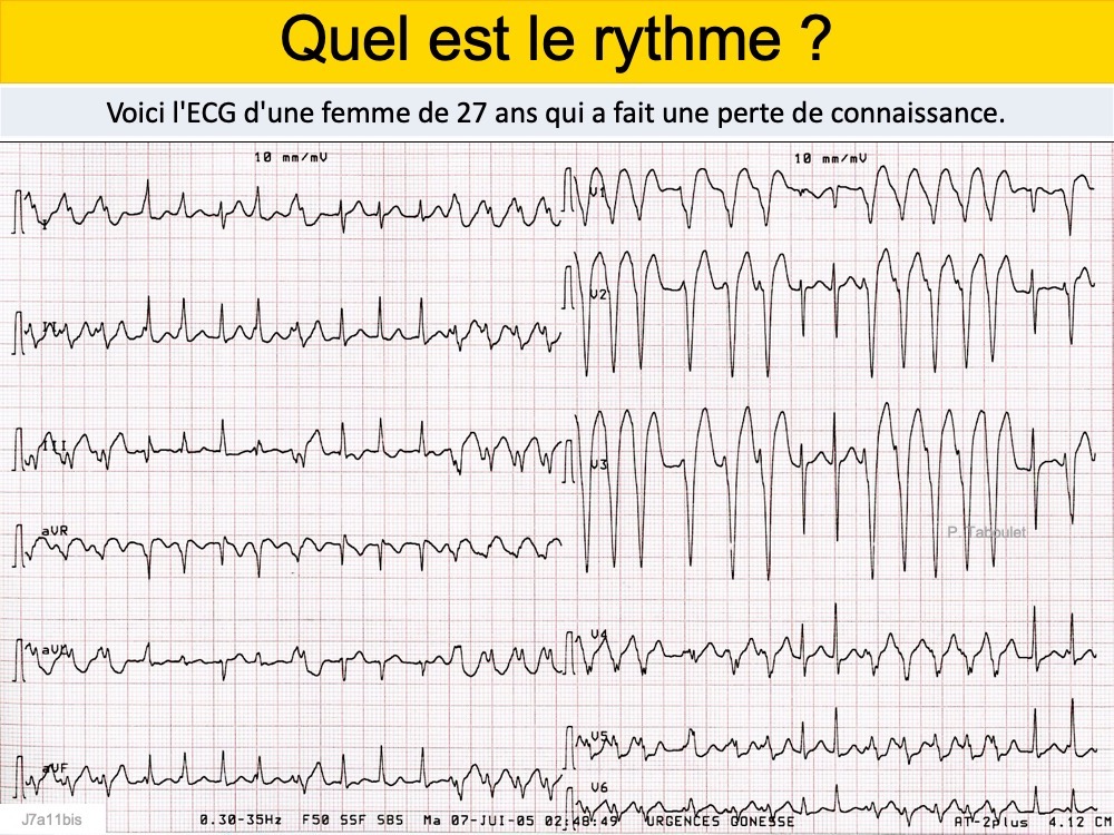 SCA Diagnostics différentiels e cardiogram