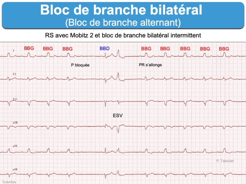 Bloc De Branche Bilat Ral E Cardiogram