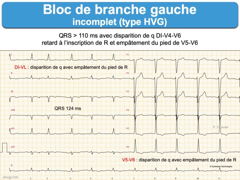 Bloc De Branche 3 Gauche Incomplet E Cardiogram