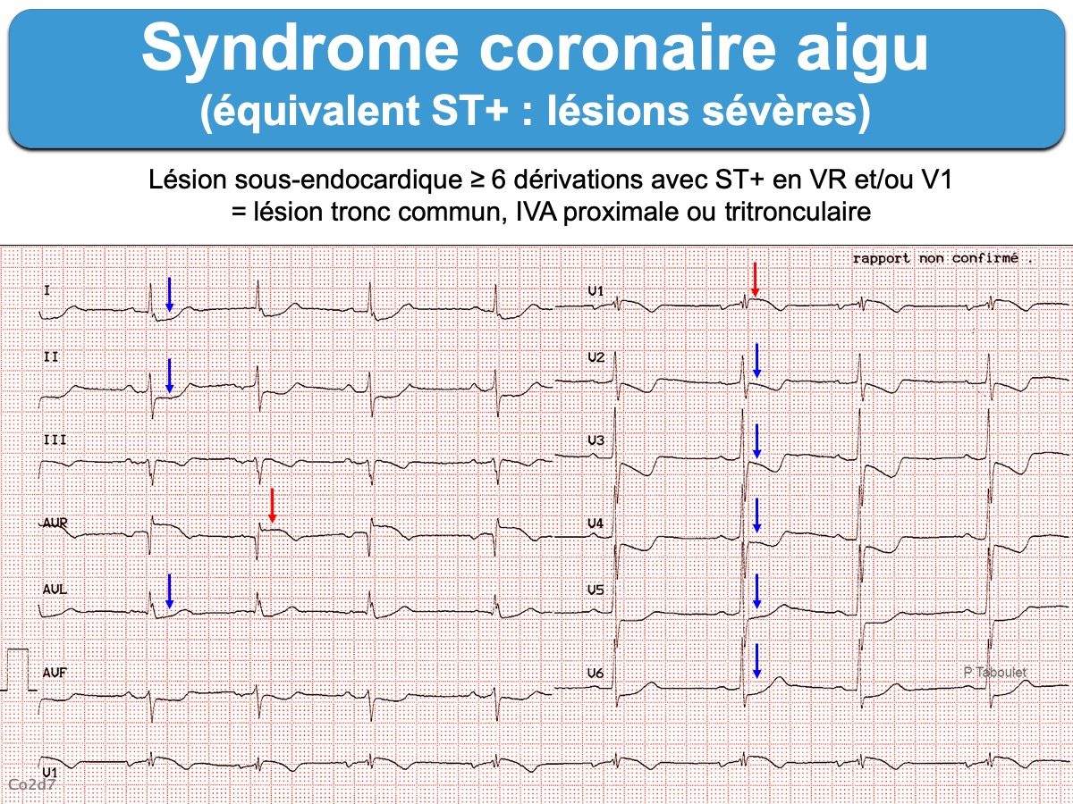 SCA 3b Non ST équivalents ST e cardiogram