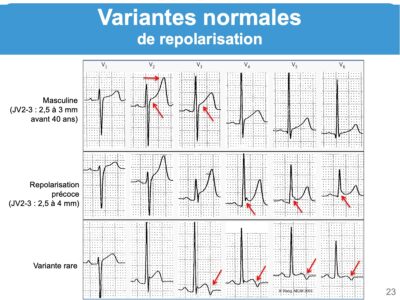 Variantes Repolarisation Ventriculaire E Cardiogram