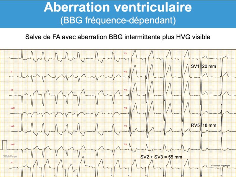 Aberration Ventriculaire (bbd Ou Bbg) : E-cardiogram