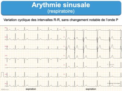 Variabilité Sinusale : E-cardiogram