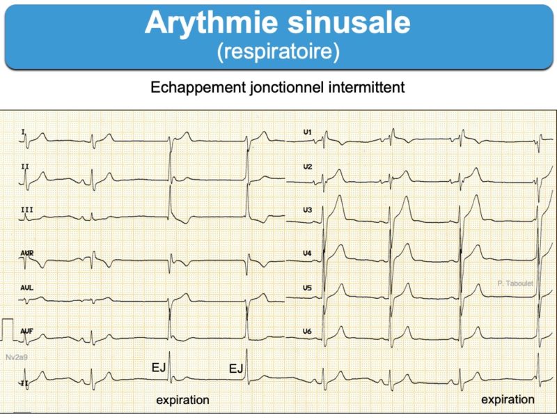 Arythmie Sinusale Respiratoire : E-cardiogram