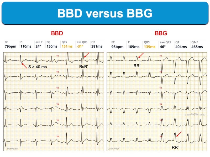 Bloc De Branche 1. Généralités : E-cardiogram