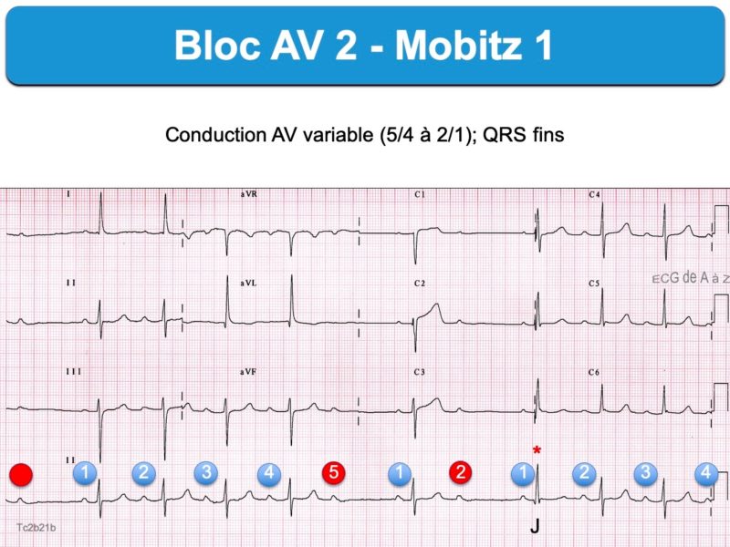 Bloc AV 2e degré. Mobitz 1 : e-cardiogram