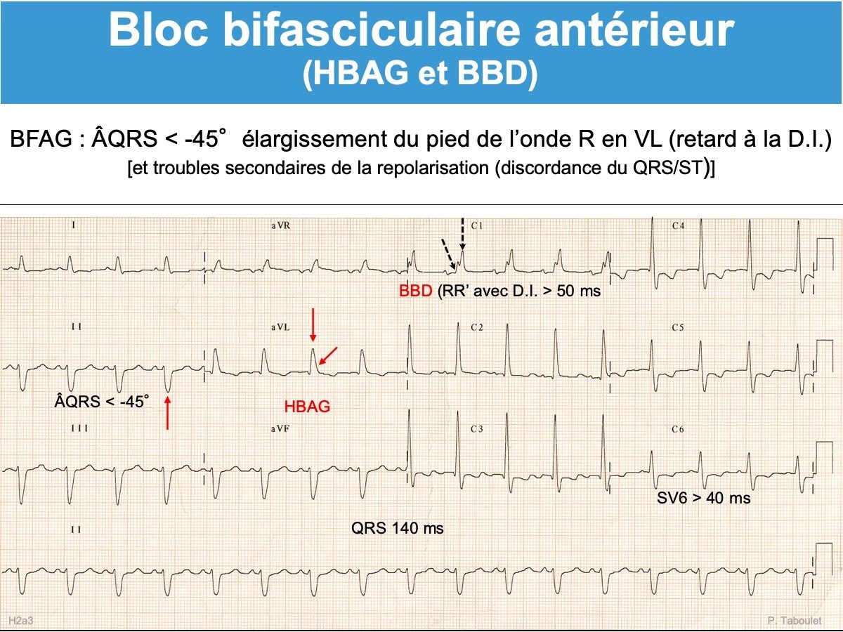 Bloc Bifasciculaire E Cardiogram