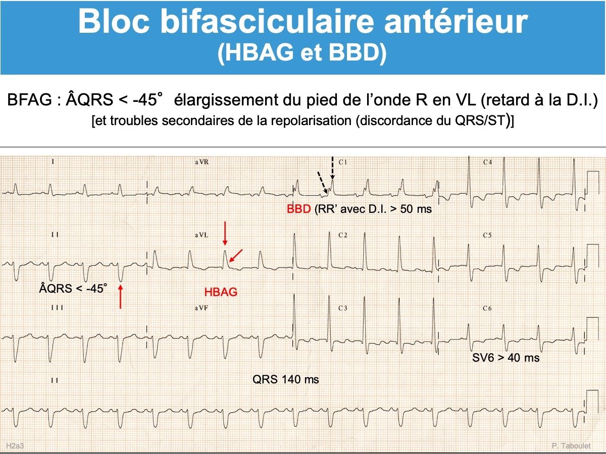 Bloc Bifasciculaire : E-cardiogram