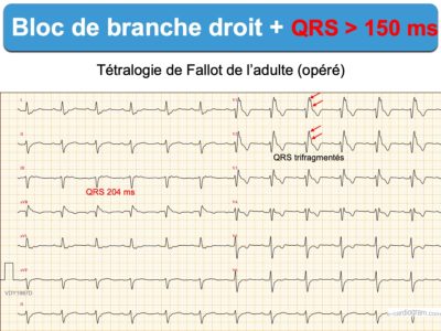 Bloc De Branche 2. Droit Complet : E-cardiogram