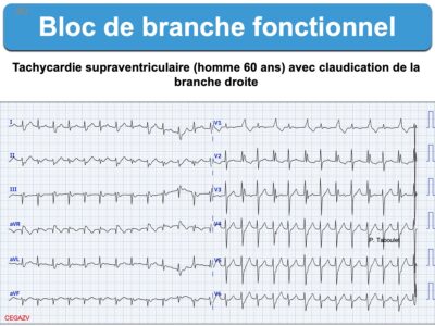 Bloc De Branche 6. Fonctionnel : E-cardiogram