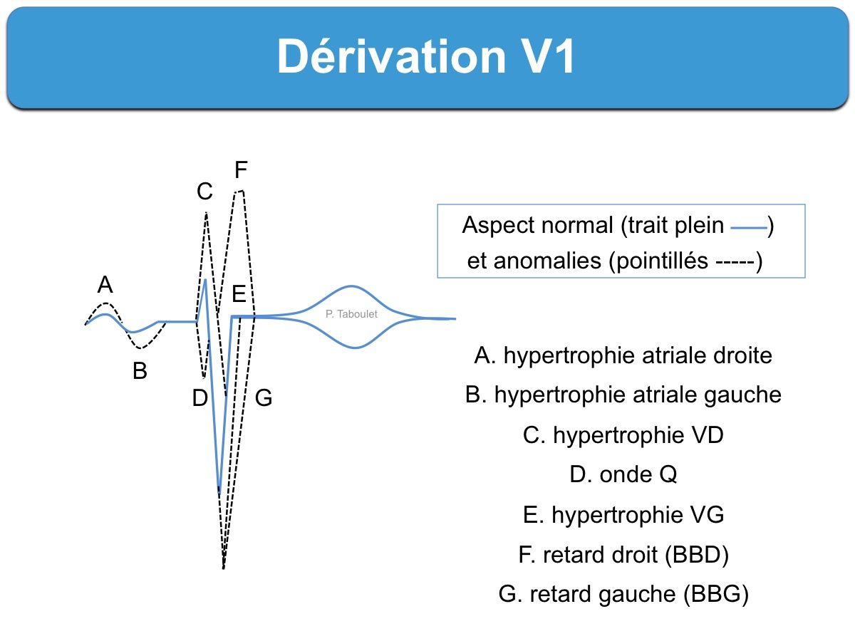 Derivations Precordiales E Cardiogram