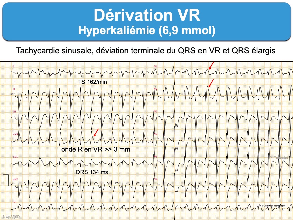 Derivation Vr E Cardiogram