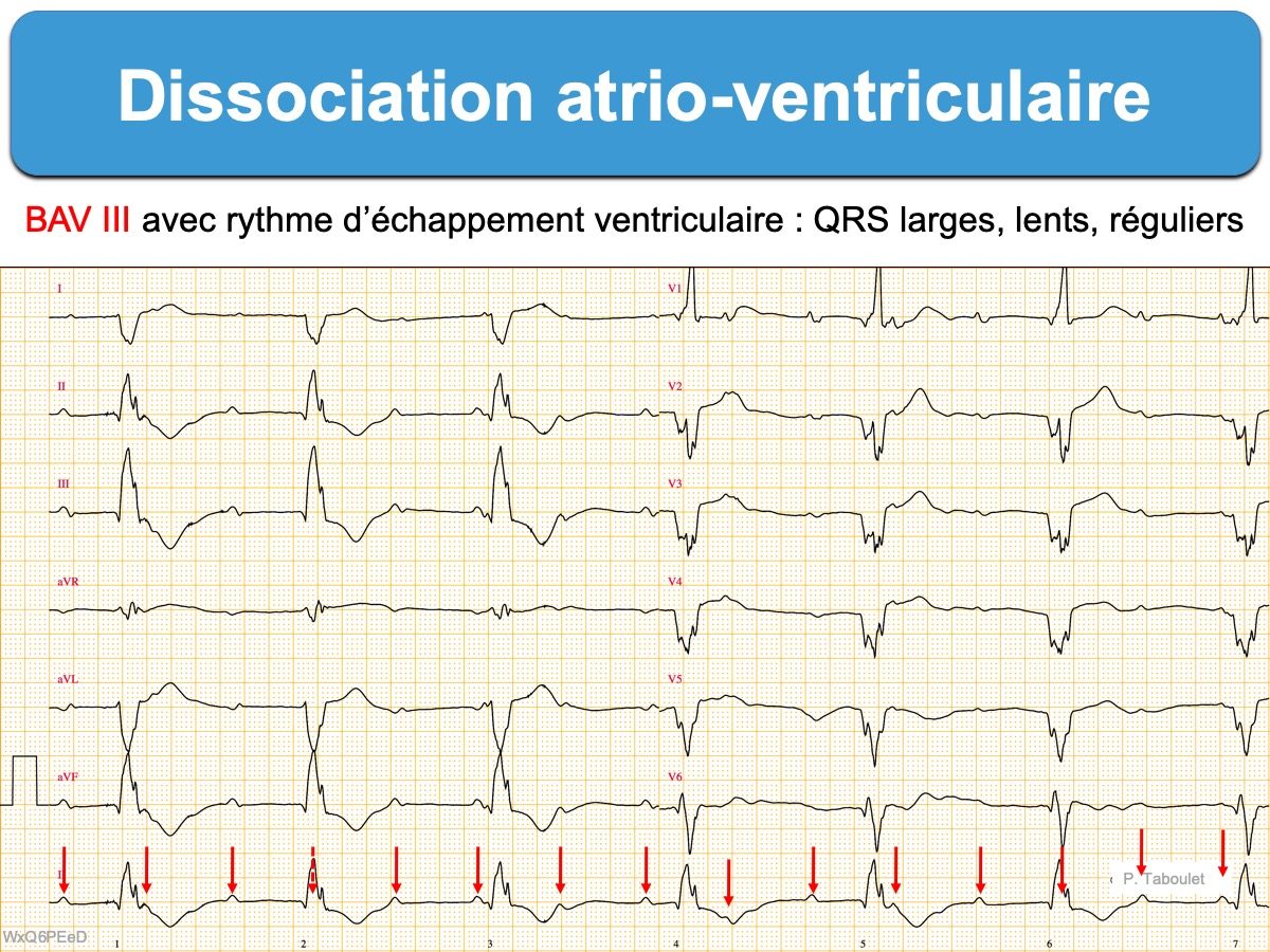 Dissociation Atrio-ventriculaire : E-cardiogram