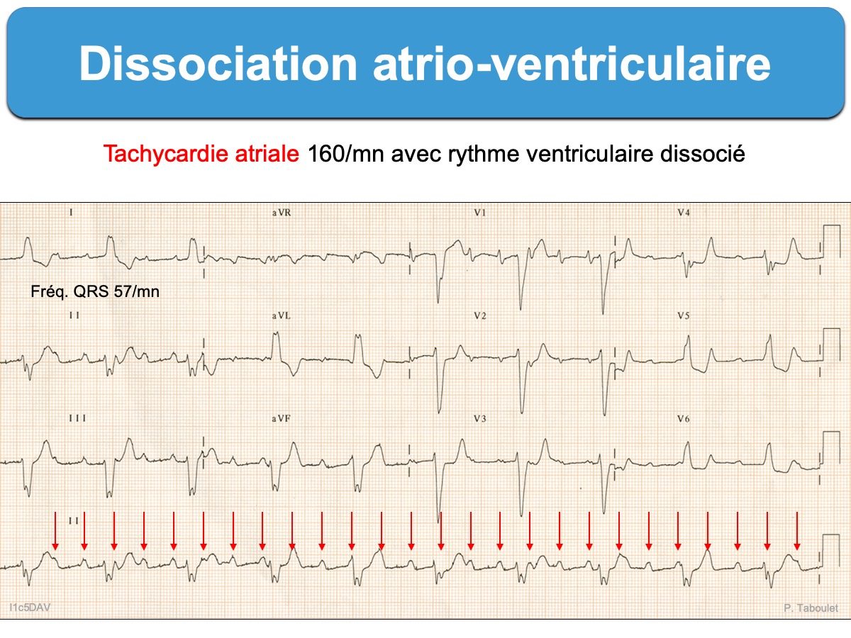 Dissociation atrio-ventriculaire : e-cardiogram