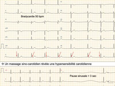 Dysfonction Sinusale : E-cardiogram