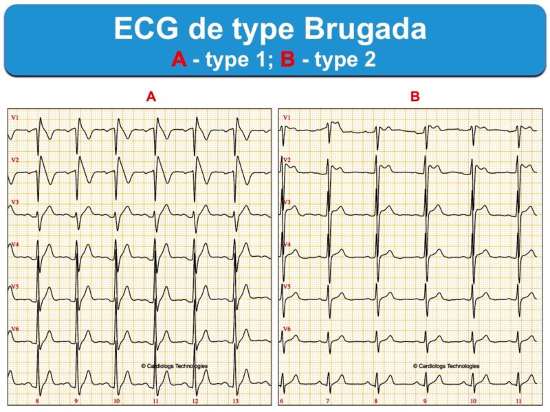 ECG Brugada Type 1 Ou 2 : E-cardiogram