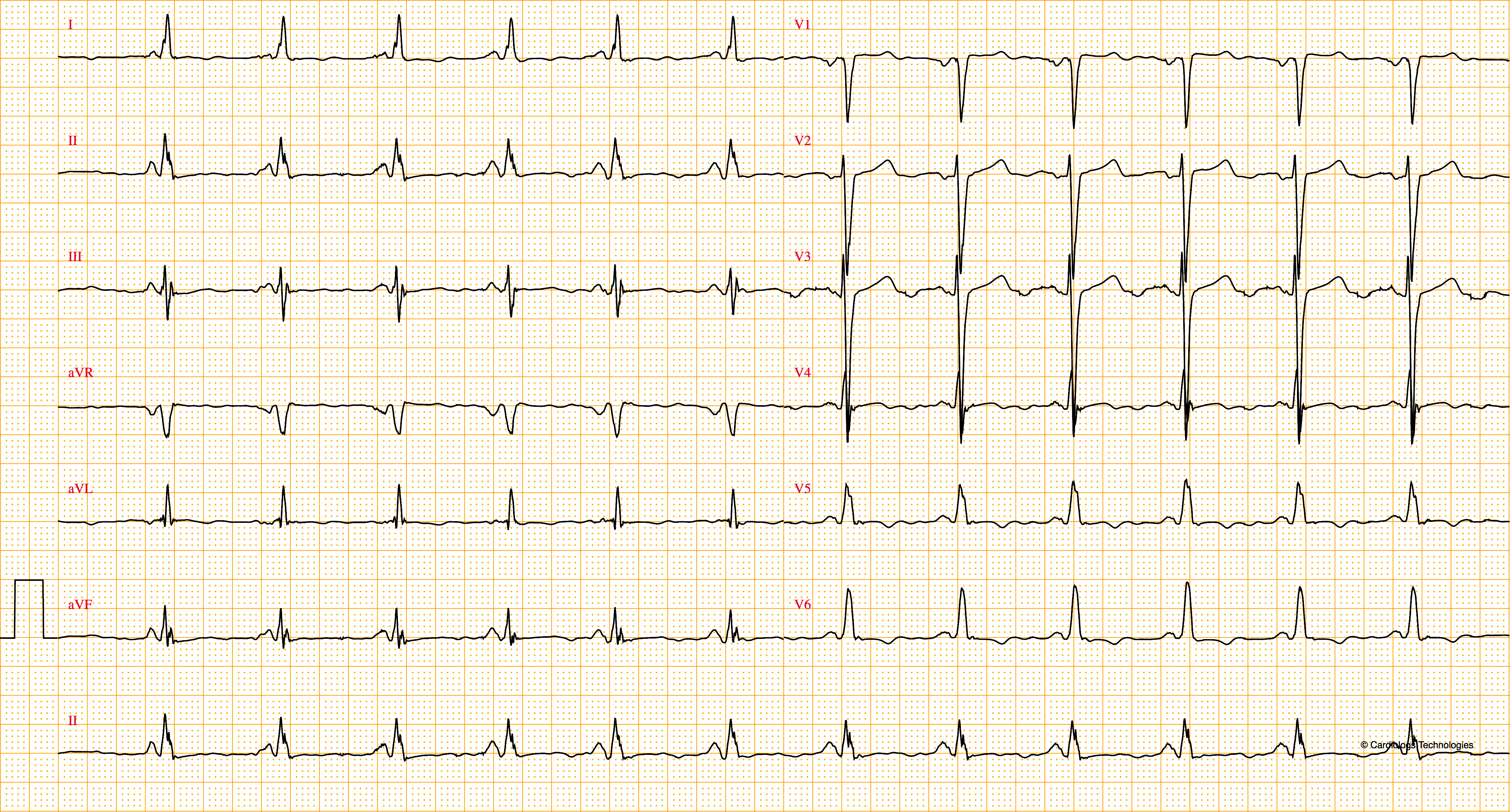 Bloc De Branche 3 Gauche Incomplet E Cardiogram