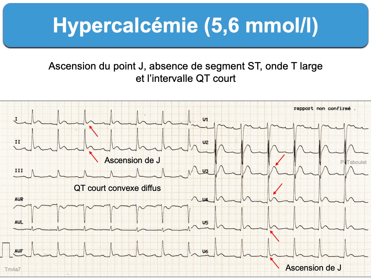 Hypercalcemie E Cardiogram