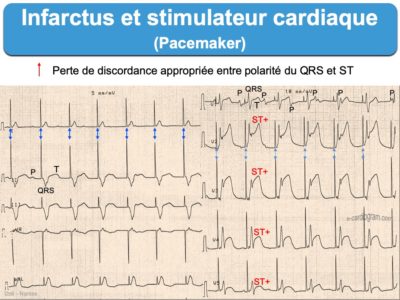 Infarctus 5. QRS larges : e-cardiogram