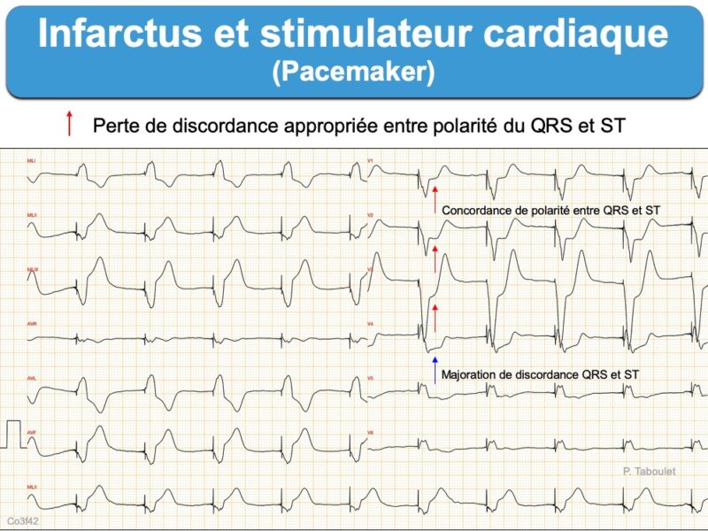 Infarctus 6c. Pacemaker : e-cardiogram