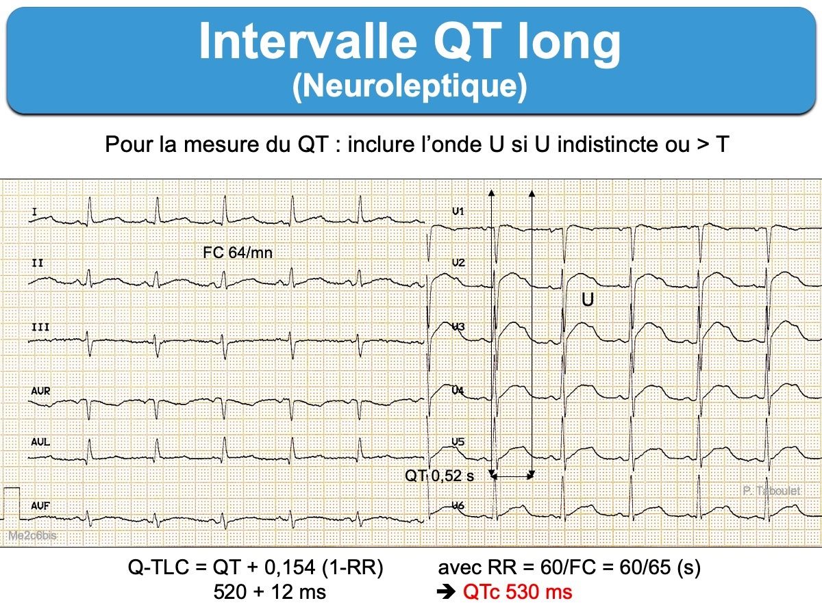 Intervalle QT. 4a. Long : E-cardiogram