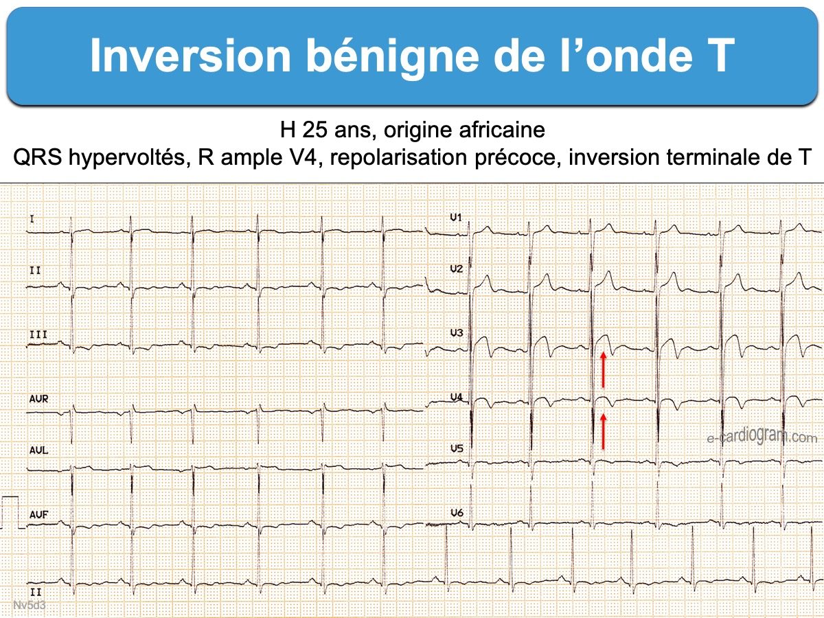Inversion Benigne De L Onde T E Cardiogram