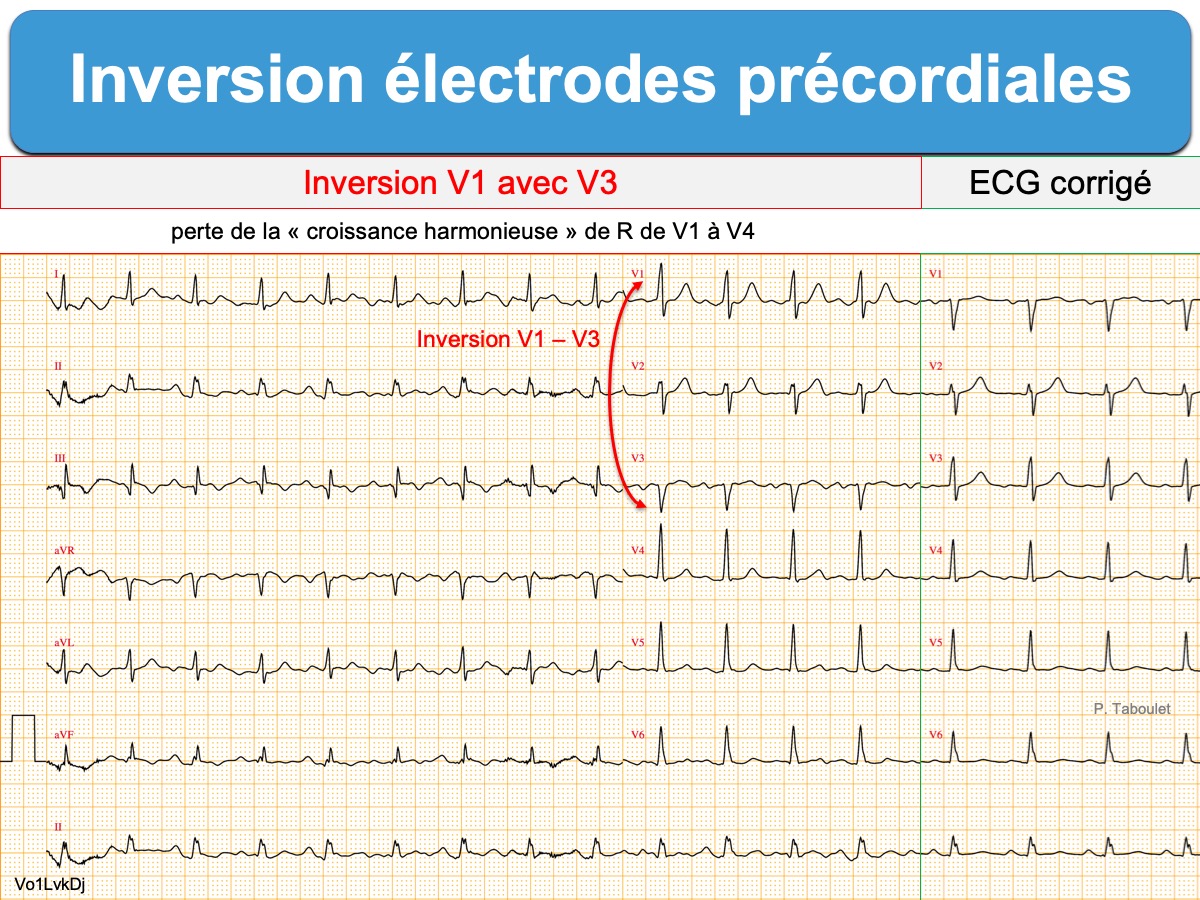 Progression Harmonieuse Des Ondes R E Cardiogram