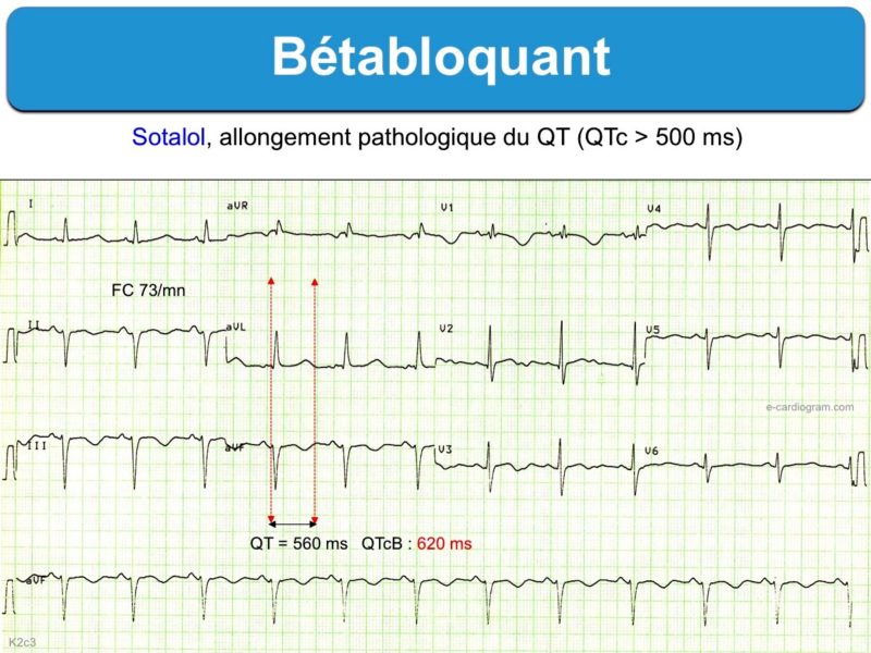 Betabloquants E Cardiogram