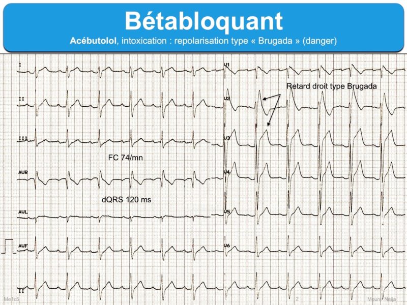 Betabloquants E Cardiogram