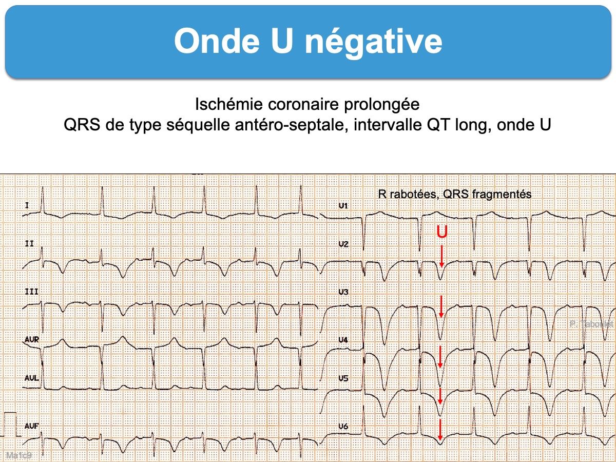 Onde U E Cardiogram