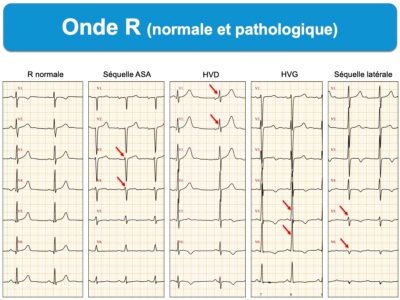 Onde R : E-cardiogram