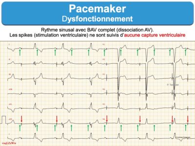 Pacemaker 5. Dysfonctionnement : E-cardiogram