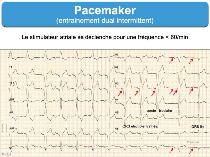 Pacemaker 3. Signes ECG : E-cardiogram