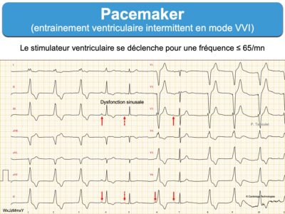 Pacemaker 3. Signes ECG : E-cardiogram