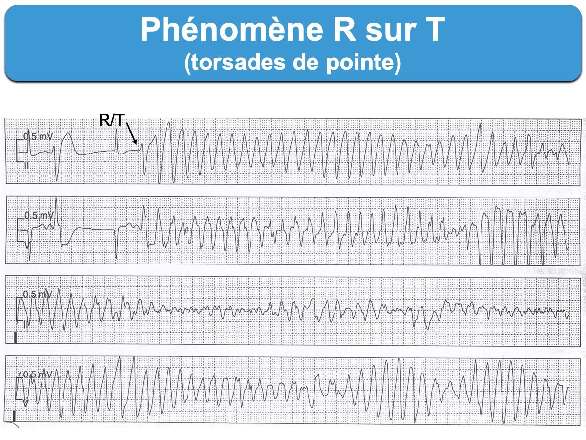 Phenomene R Sur T E Cardiogram