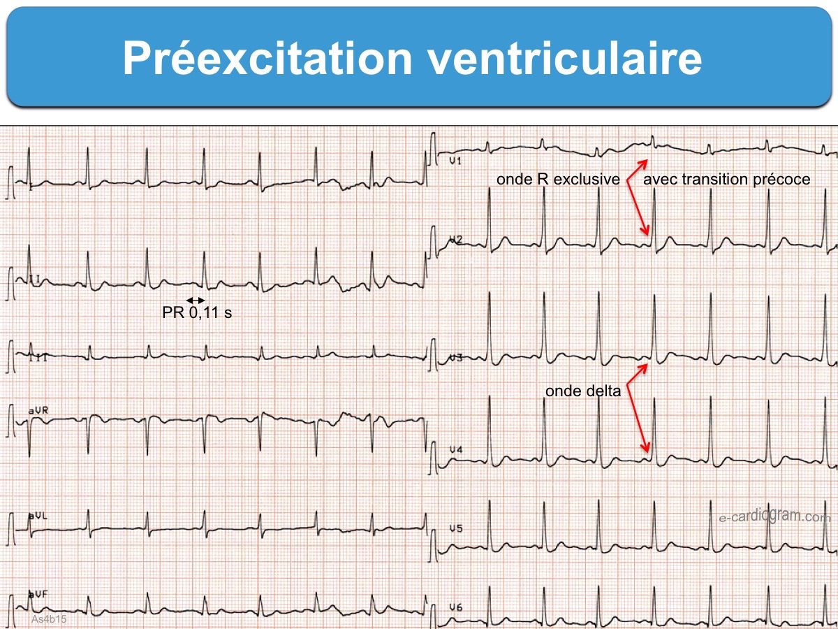 Préexcitation 1. Généralités : E-cardiogram