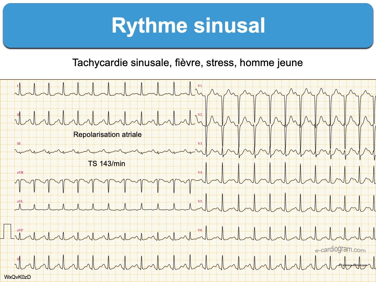 Rythme Sinusal : E-cardiogram