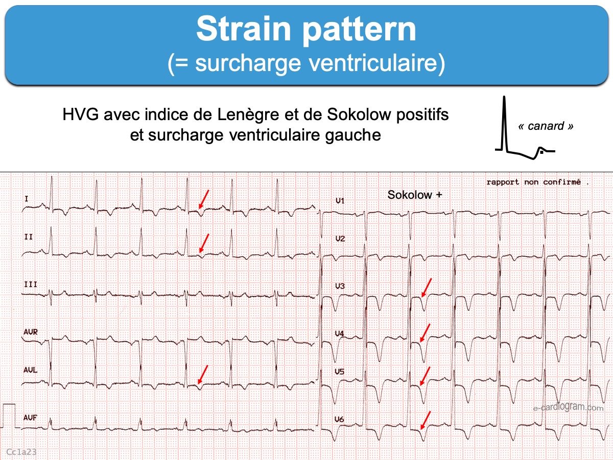 Strain pattern ecardiogram