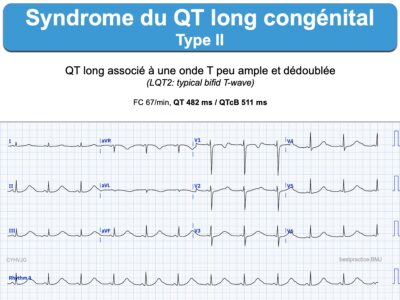 Syndrome Du Qt Long Congénital : E-cardiogram