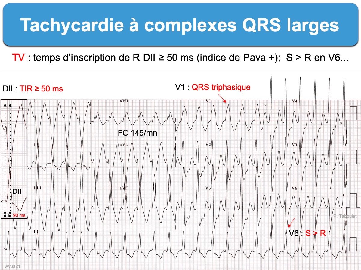 Tachycardies A Qrs Larges E Cardiogram
