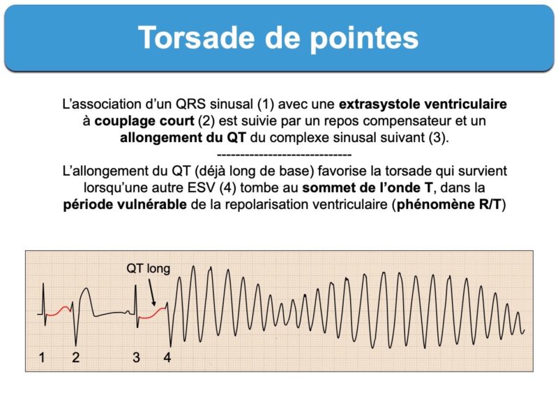 torsade-de-pointes-e-cardiogram