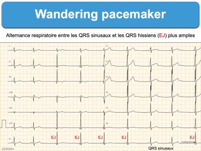 Wandering Pacemaker (WPM) : E-cardiogram