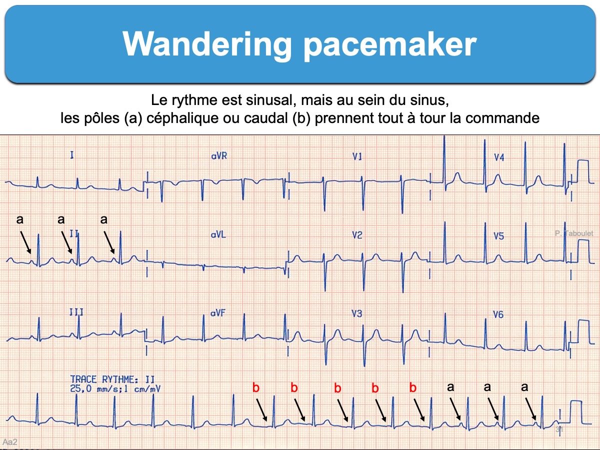 what is a wandering pacemaker rhythm