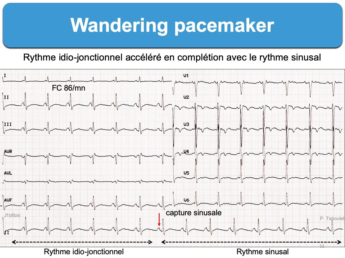 wandering atrial pacemaker dangerous