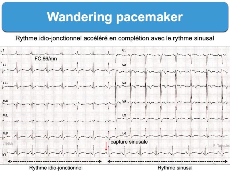 what does wandering atrial pacemaker mean