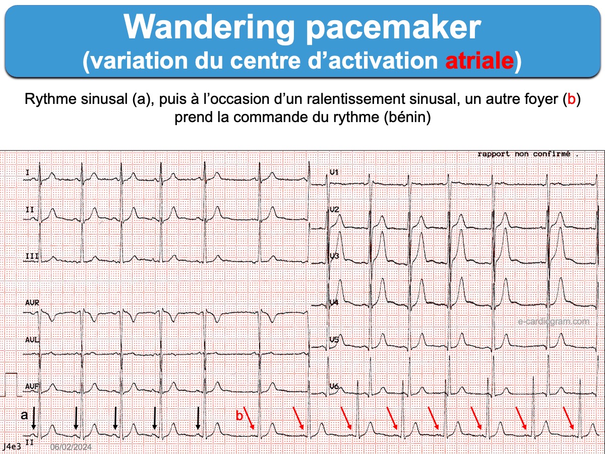 wandering pacemaker translation