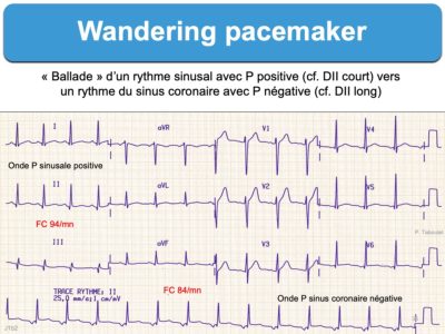 Wandering Pacemaker : E-cardiogram